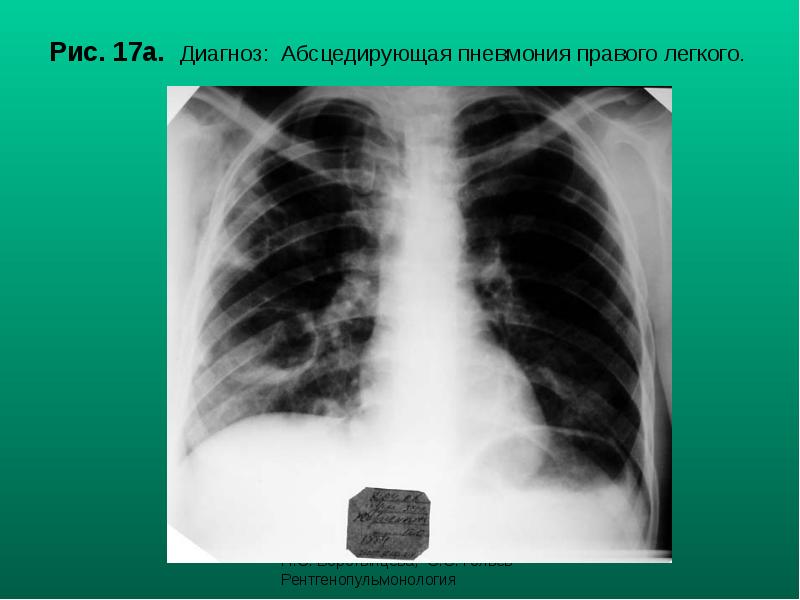 Рис. 17а. Диагноз: Абсцедирующая пневмония правого легкого. Рис. 17а. Диагноз: Абсцедирующая пневмония правого легкого.