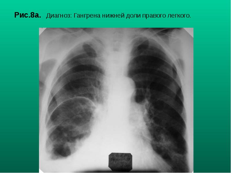 Рис.8а. Диагноз: Гангрена нижней доли правого легкого. Рис.8а. Диагноз: Гангрена нижней доли правого легкого.