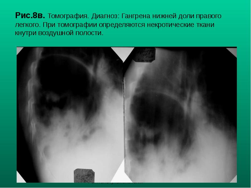 Рис.8в. Томография. Диагноз: Гангрена нижней доли правого легкого. При томографии определяются Рис.8в. Томография. Диагноз: Гангрена нижней доли правого легкого. При томографии определяются