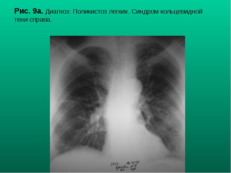 Рис. 9а. Диагноз: Поликистоз легких. Синдром кольцевидной тени справа. Рис. 9а. Диагноз: Поликистоз легких. Синдром кольцевидной тени справа.