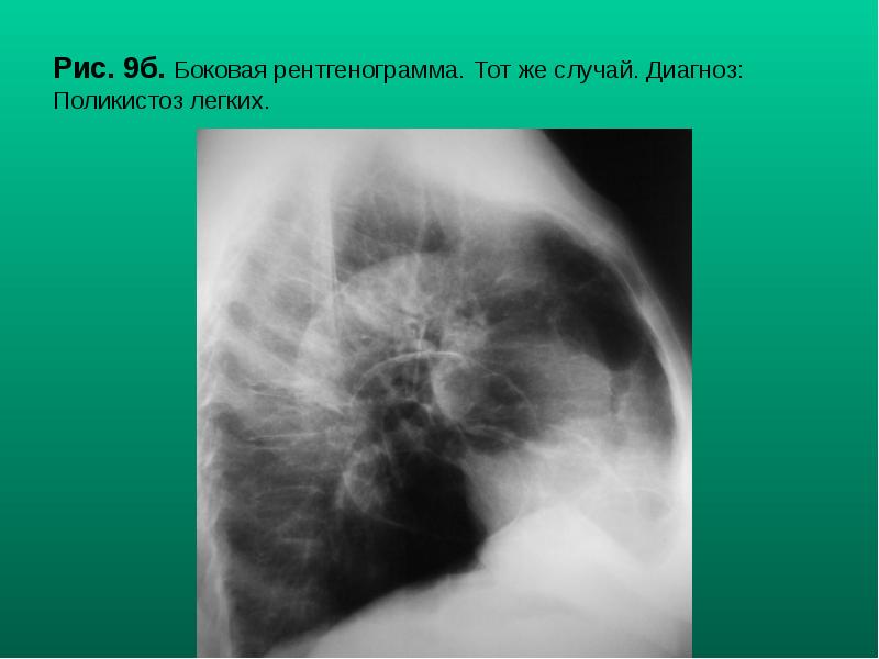 Рис. 9б. Боковая рентгенограмма. Тот же случай. Диагноз: Поликистоз легких. Рис. 9б. Боковая рентгенограмма. Тот же случай. Диагноз: Поликистоз легких.