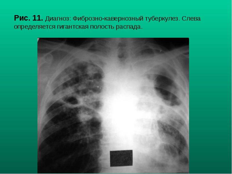 Рис. 11. Диагноз: Фиброзно-кавернозный туберкулез. Слева определяется гигантская полость распада. Рис. 11. Диагноз: Фиброзно-кавернозный туберкулез. Слева определяется гигантская полость распада.