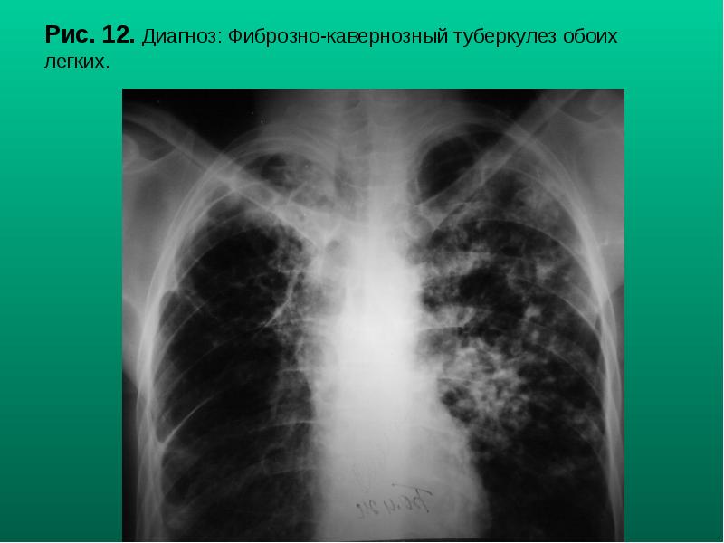 Рис. 12. Диагноз: Фиброзно-кавернозный туберкулез обоих легких. Рис. 12. Диагноз: Фиброзно-кавернозный туберкулез обоих легких.