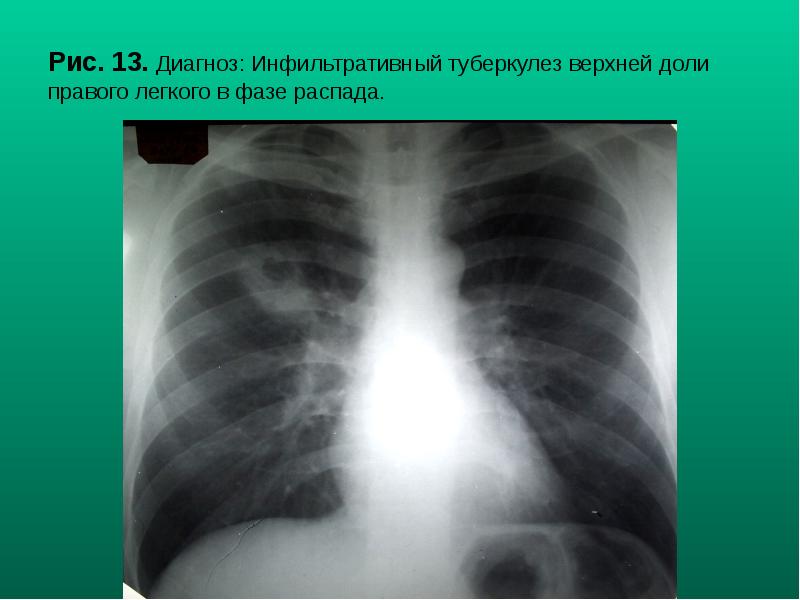 Рис. 13. Диагноз: Инфильтративный туберкулез верхней доли правого легкого в фазе Рис. 13. Диагноз: Инфильтративный туберкулез верхней доли правого легкого в фазе