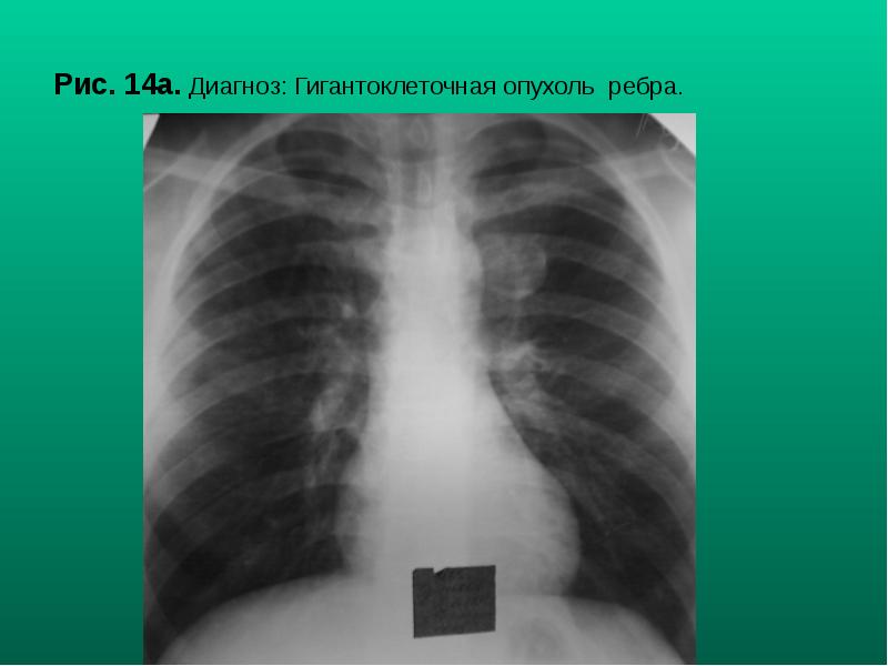 Рис. 14а. Диагноз: Гигантоклеточная опухоль ребра. Рис. 14а. Диагноз: Гигантоклеточная опухоль ребра.