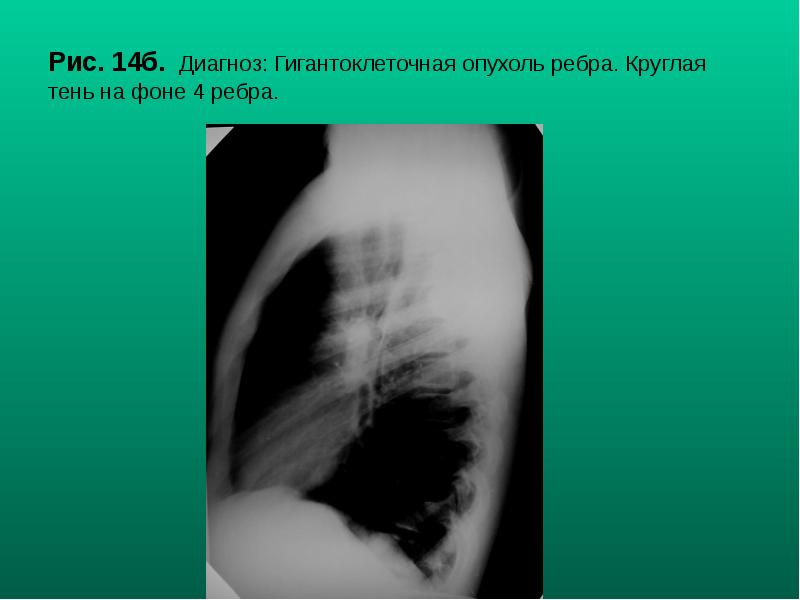 Рис. 14б. Диагноз: Гигантоклеточная опухоль ребра. Круглая тень на фоне 4 Рис. 14б. Диагноз: Гигантоклеточная опухоль ребра. Круглая тень на фоне 4