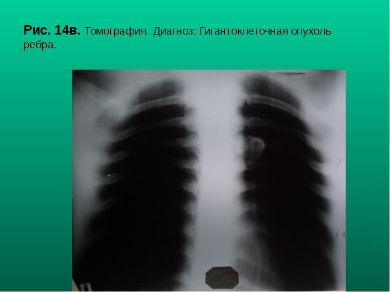 Рис. 14в. Томография. Диагноз: Гигантоклеточная опухоль ребра. Рис. 14в. Томография. Диагноз: Гигантоклеточная опухоль ребра.