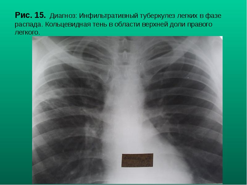 Рис. 15. Диагноз: Инфильтративный туберкулез легких в фазе распада. Кольцевидная тень Рис. 15. Диагноз: Инфильтративный туберкулез легких в фазе распада. Кольцевидная тень