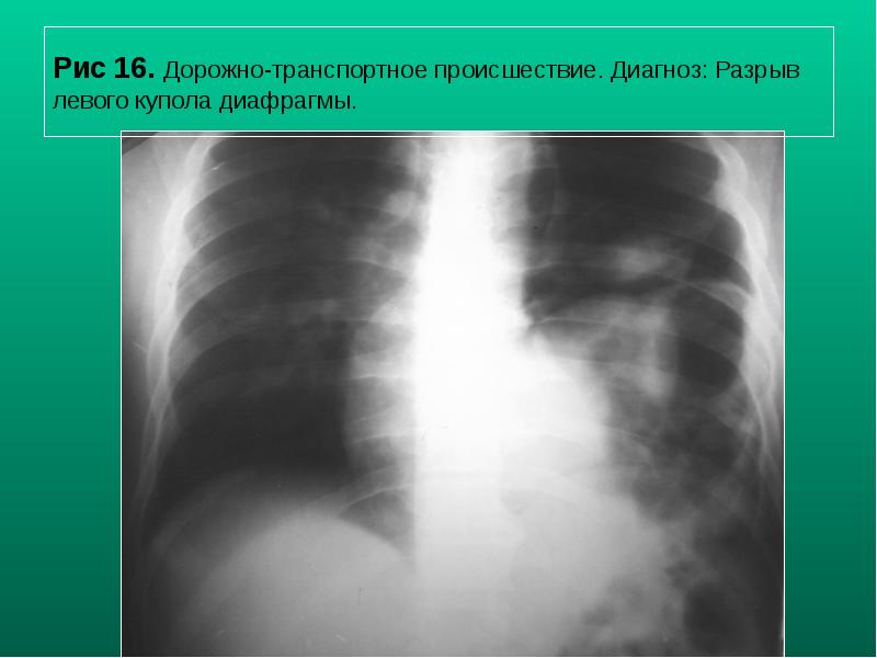 Рис 16. Дорожно-транспортное происшествие. Диагноз: Разрыв левого купола диафрагмы. Рис 16. Дорожно-транспортное происшествие. Диагноз: Разрыв левого купола диафрагмы.