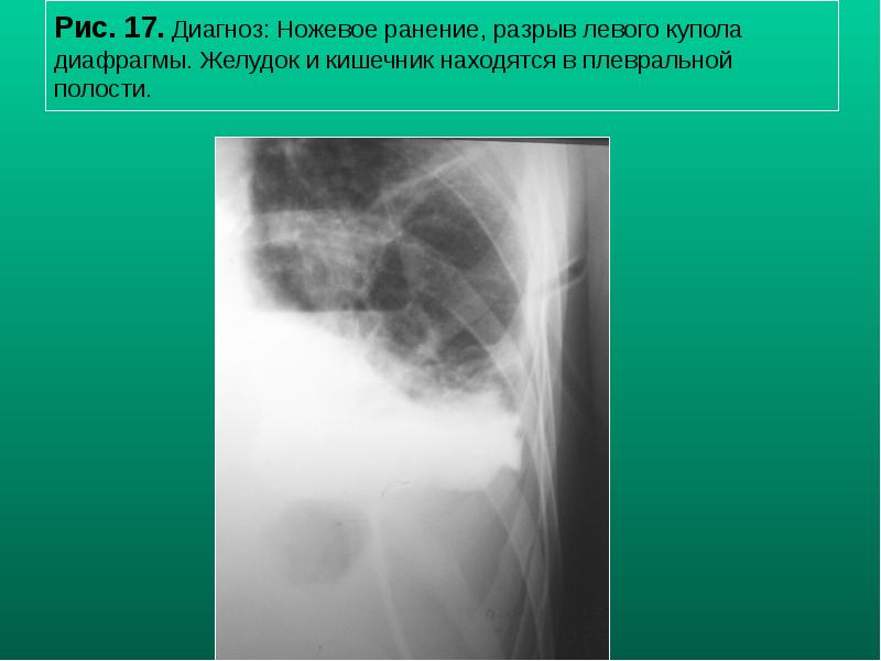 Рис. 17. Диагноз: Ножевое ранение, разрыв левого купола диафрагмы. Желудок и Рис. 17. Диагноз: Ножевое ранение, разрыв левого купола диафрагмы. Желудок и