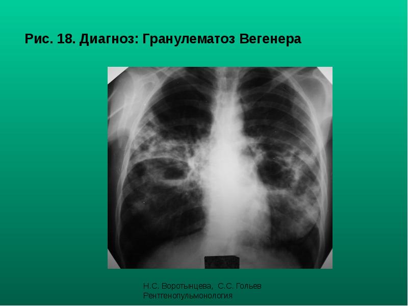 Рис. 18. Диагноз: Гранулематоз Вегенера Рис. 18. Диагноз: Гранулематоз Вегенера