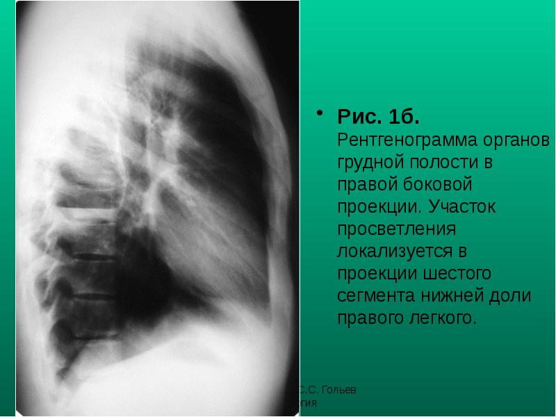 Рис. 1б. Рентгенограмма органов грудной полости в правой боковой проекции. Участок Рис. 1б. Рентгенограмма органов грудной полости в правой боковой проекции. Участок