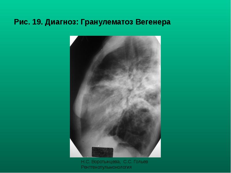 Рис. 19. Диагноз: Гранулематоз Вегенера Рис. 19. Диагноз: Гранулематоз Вегенера