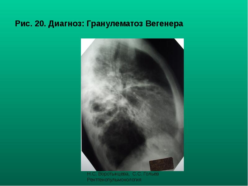 Рис. 20. Диагноз: Гранулематоз Вегенера Рис. 20. Диагноз: Гранулематоз Вегенера