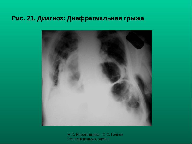 Рис. 21. Диагноз: Диафрагмальная грыжа Рис. 21. Диагноз: Диафрагмальная грыжа