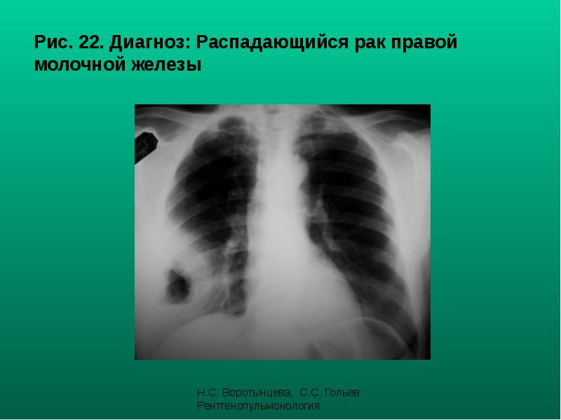 Рис. 22. Диагноз: Распадающийся рак правой молочной железы Рис. 22. Диагноз: Распадающийся рак правой молочной железы