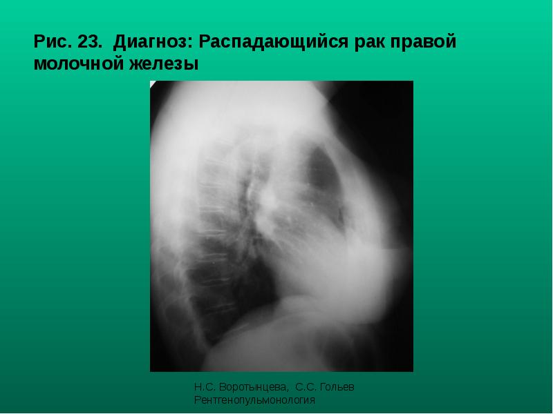 Рис. 23. Диагноз: Распадающийся рак правой молочной железы Рис. 23. Диагноз: Распадающийся рак правой молочной железы