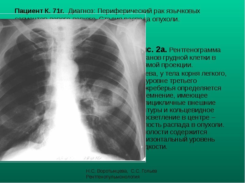 Диагноз корень. Опухоль легкого с распадом. Опухоль с распадом на рентгене. Распад легкого на рентгене. Кольцевидные тени в легких на рентгене.