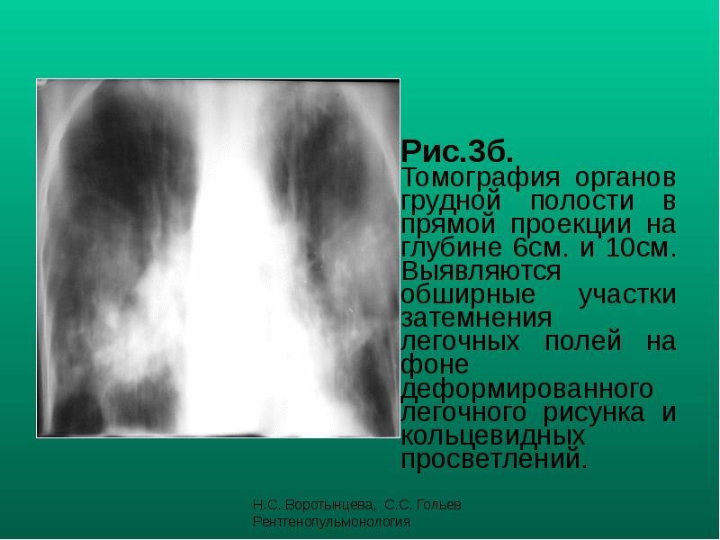 Рис.3б. Томография органов грудной полости в прямой проекции на глубине 6см. Рис.3б. Томография органов грудной полости в прямой проекции на глубине 6см.