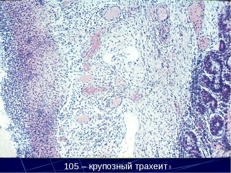 Корь патанатомия презентация