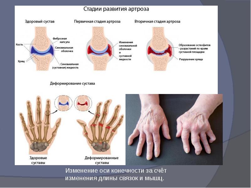 Артрит и артроз презентация