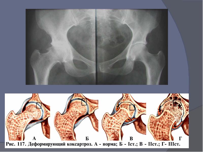 Коксартроз презентация травматология