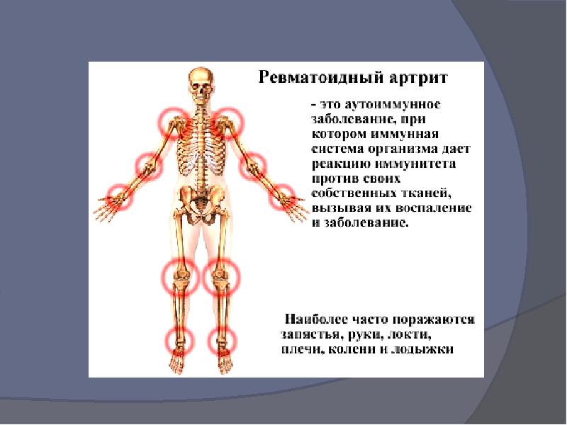 Артрит и артроз презентация