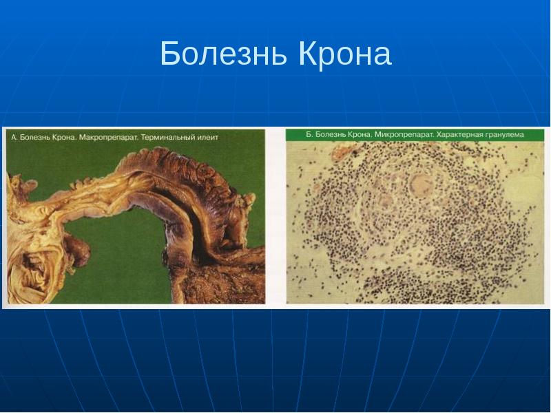 Болезням 66. Болезнь крона патологическая анатомия. Продуктивное воспаление патологическая анатомия презентация. Болезнь крона патанатомия. Продуктивное воспаление патанатомия.