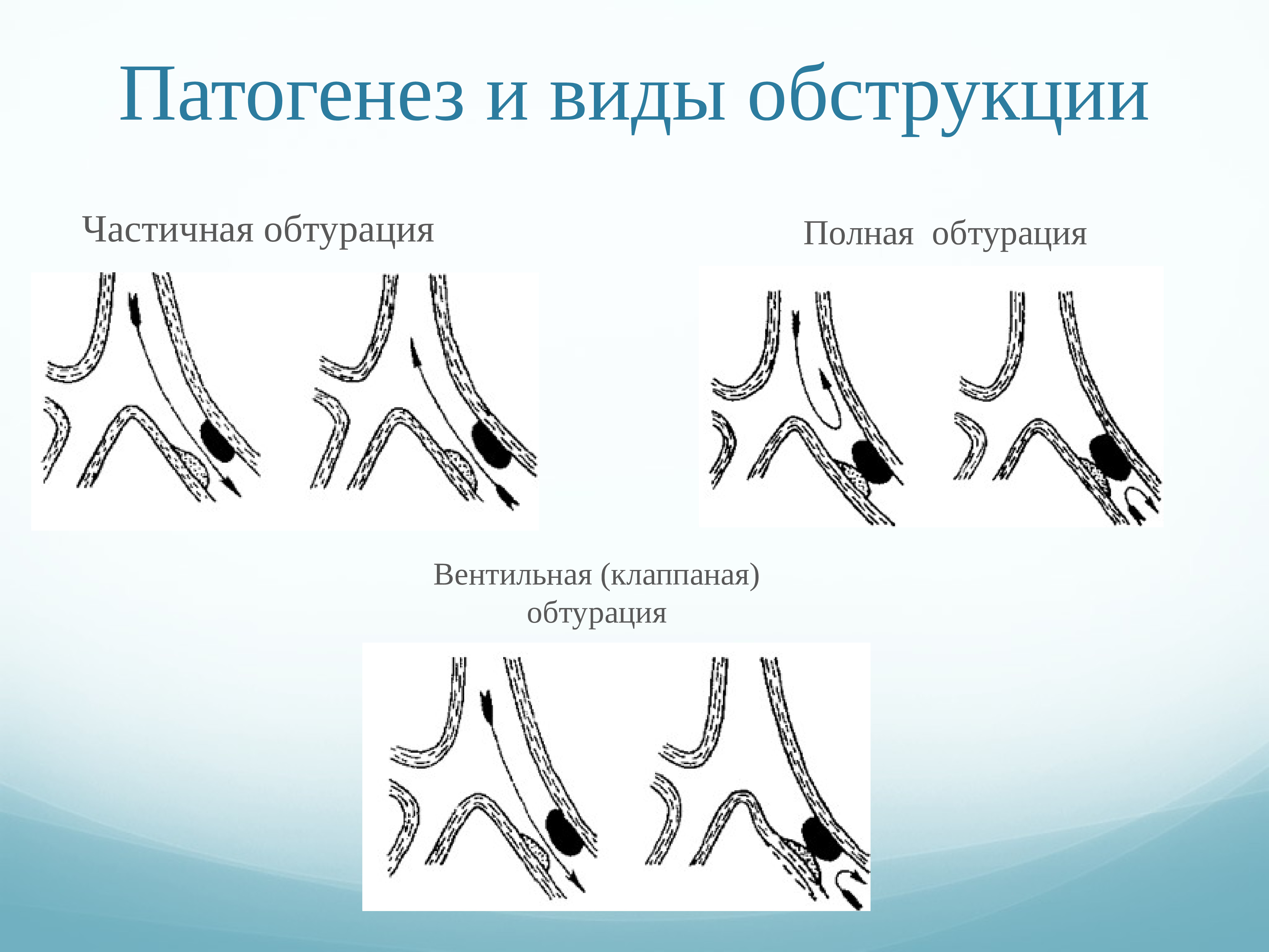 Виды обструкции дыхательных путей. Обструкция дыхательных путей патогенез. Частичная и полная обструкция дыхательных путей. Обтурация дыхательных путей виды. Закупорка дыхательных путей.
