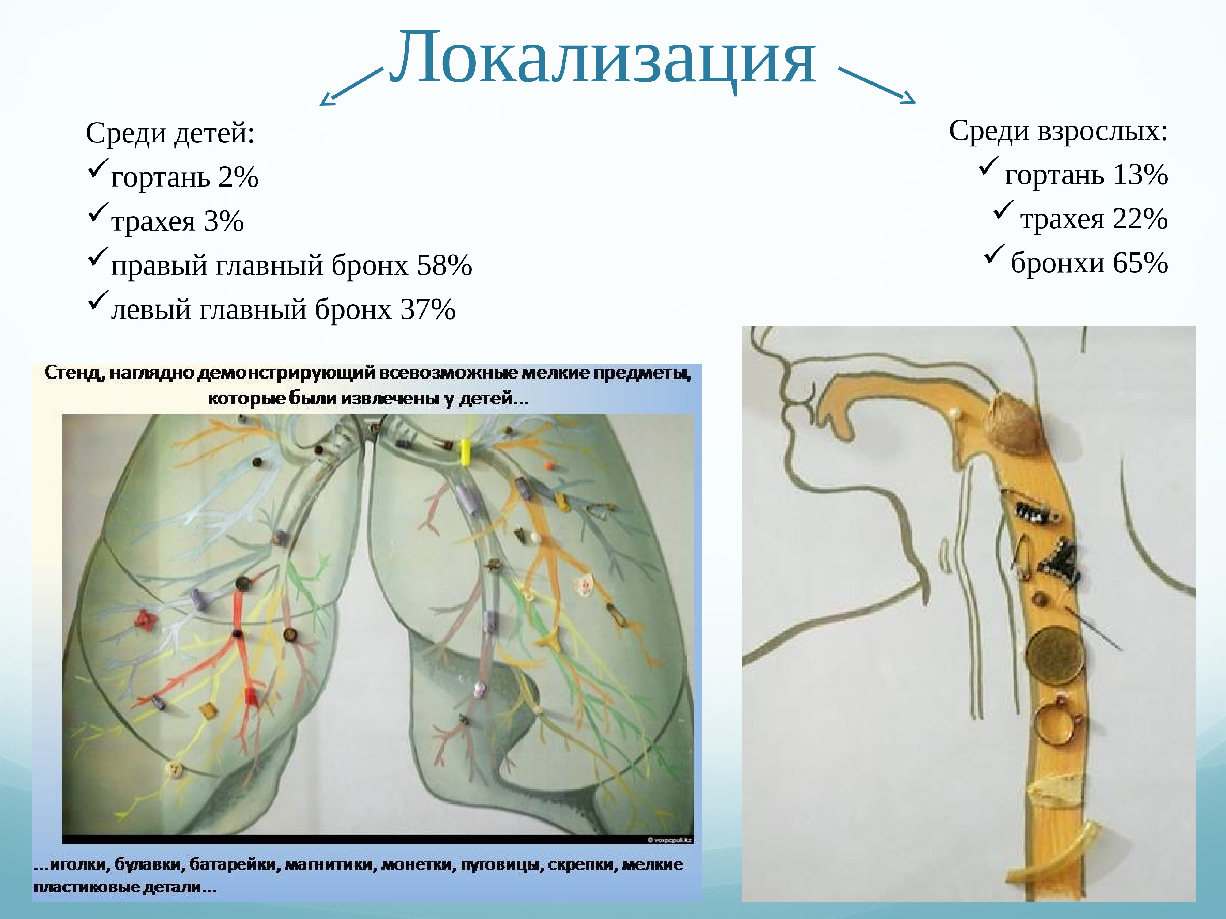 Инородные тела пищевода презентация