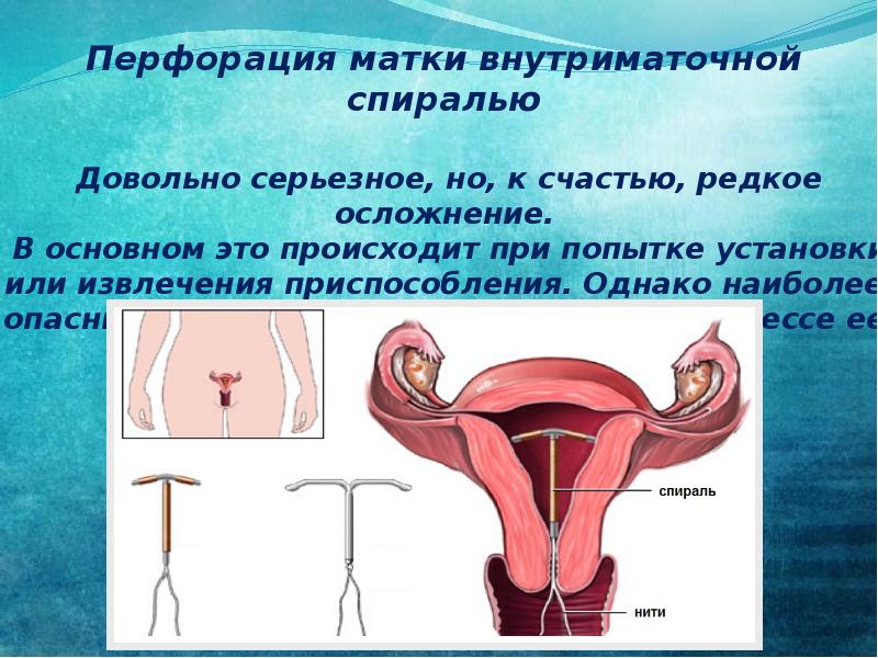 Сколько матка. Перфорация матки спиралью. Перфорация матки осложнения.