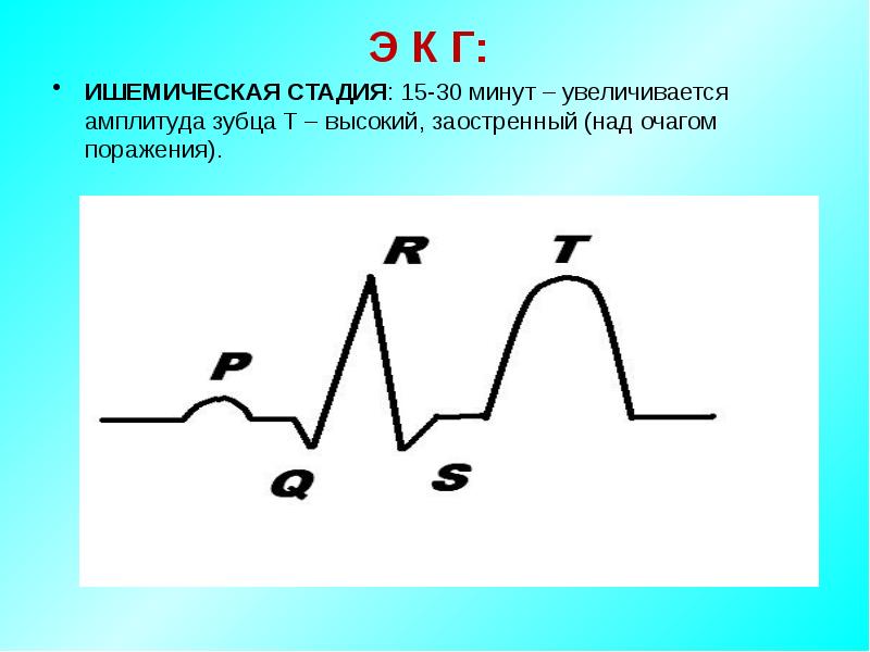 Увеличение амплитуды. Амплитуда зубца. Амплитуда зубца t. Увеличение амплитуды зубца т. Амплитуда зубца т увеличена.