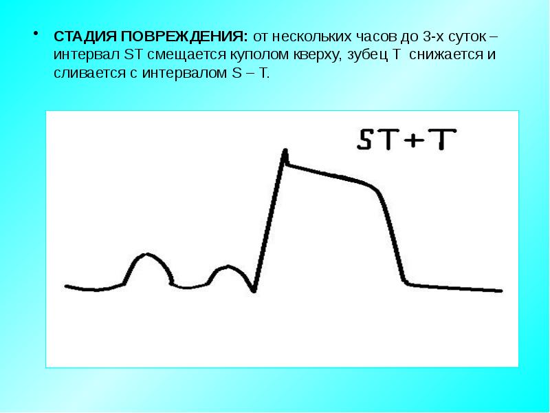 Степени разрыва. Интервал St. Зубец т сливается с зубцом п. Интервал St идет вниз. Зубец p сливается с t.