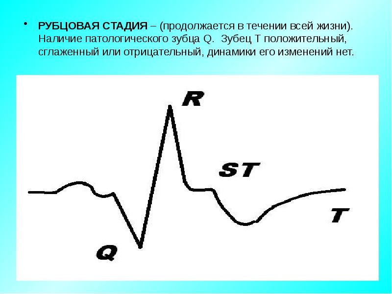 Отрицательная динамика. Сглаженный зубец т. Аномальный зубец т. Сглаживание зубца т. Положительный зубец q.