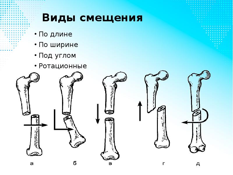 Переломы травматология презентация