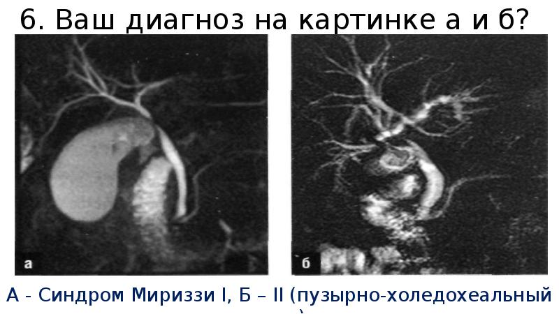 Синдром мириззи презентация