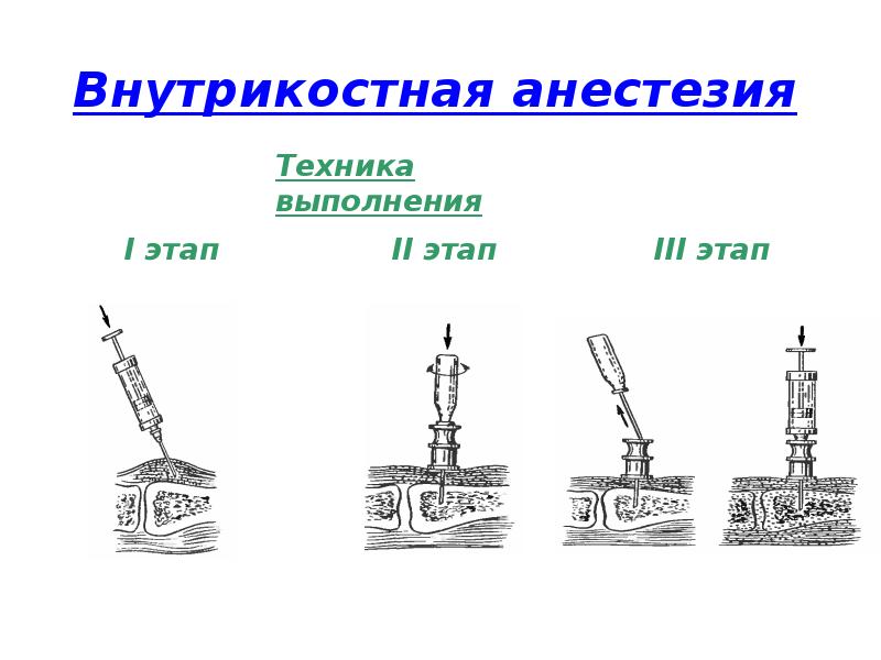 Обезболивание в травматологии презентация