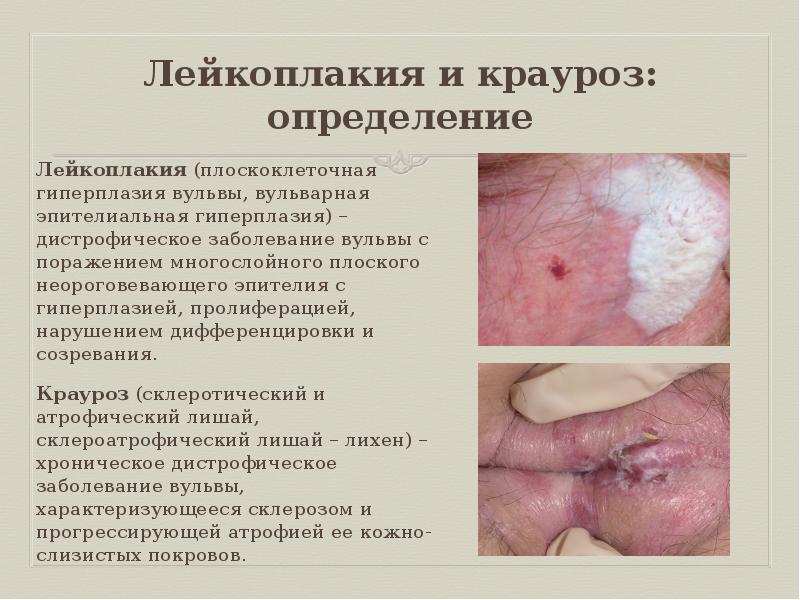 Лечение лейкоплакии наружных половых органов у женщин в Москве