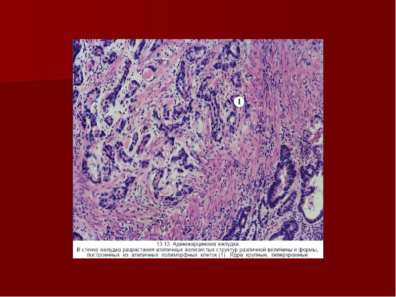 Микропрепарат аденокарцинома желудка рисунок
