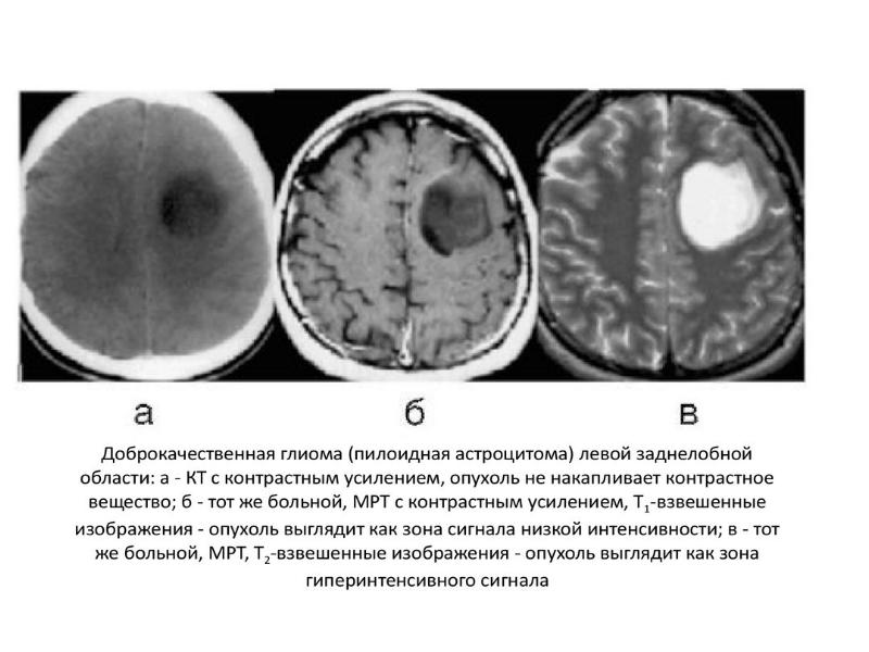 Опухоль головного мозга как выглядит на снимках мрт фото