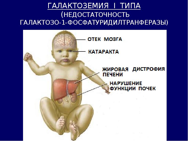 Галактоземия презентация по педиатрии