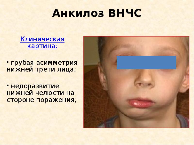 Анкилоз нижний