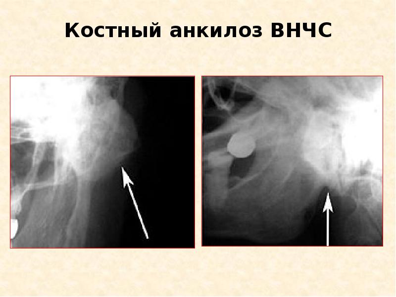 Рентгенологическая картина костного анкилоза внчс характеризуется тест