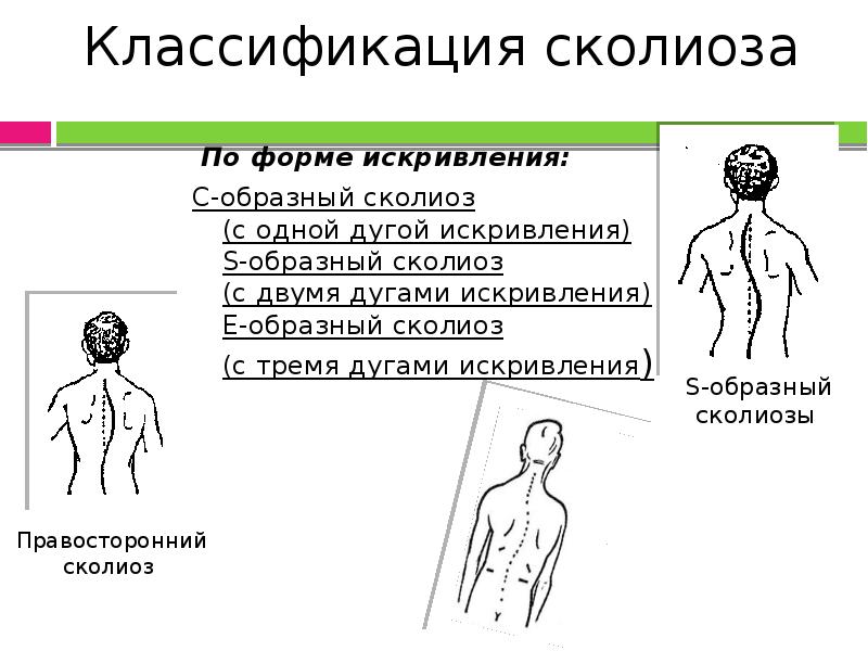 Сколиоз позвоночника презентация травматология