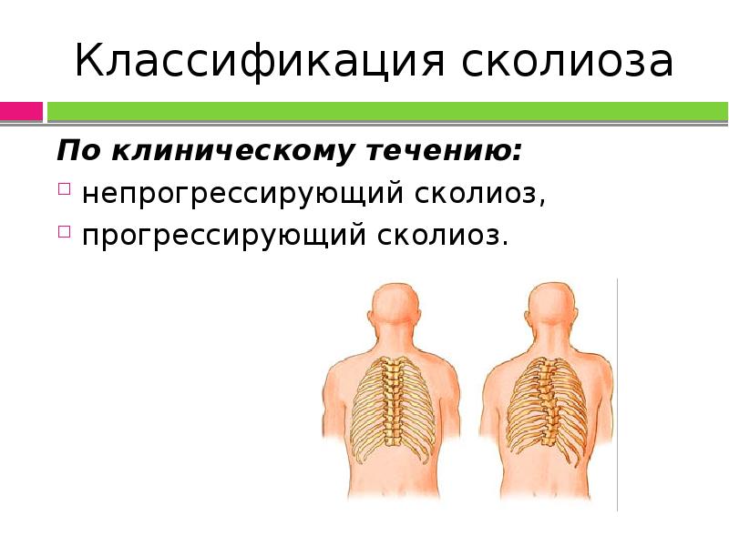 Презентация сколиоз у детей