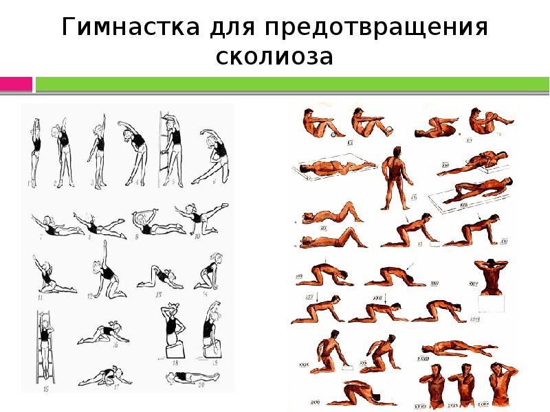 Профилактика сколиоза презентация