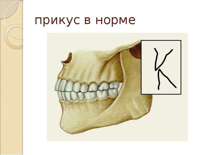 Глубокий прикус: как исправить у взрослых и детей, лечение глубокого прикуса
