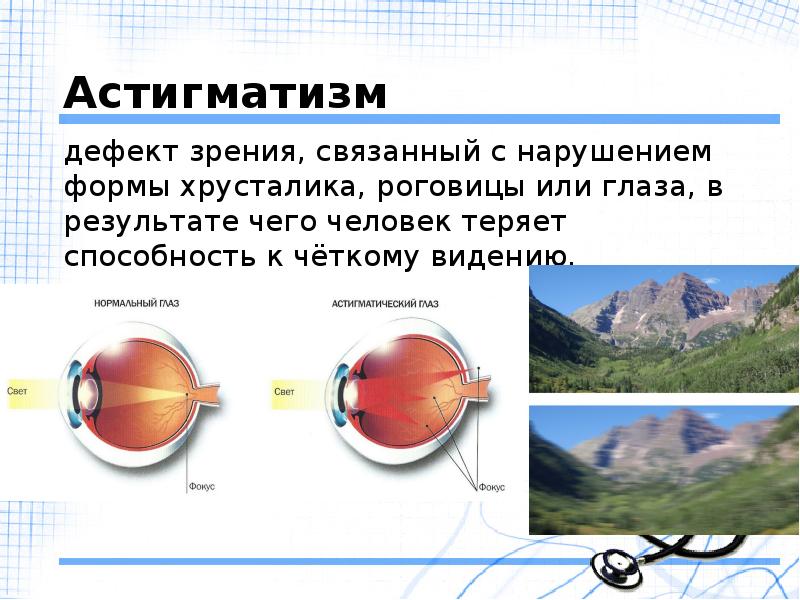 Виде или видим. Строение глаза астигматизм. Астигматизм кратко и понятно. Астигматизм обоих глаз. Астигматизм роговицы глаза.