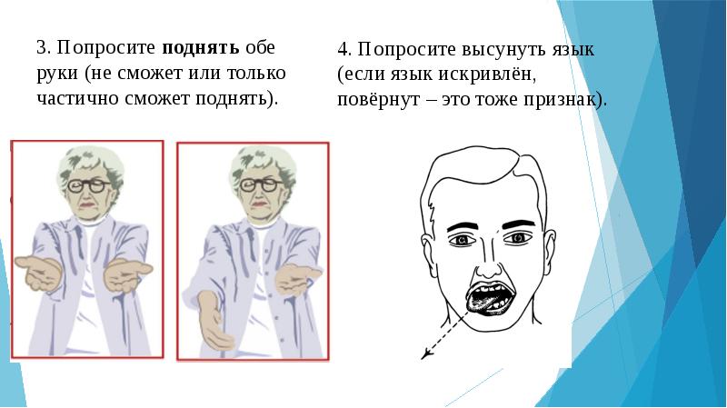 Язык при инсульте фото