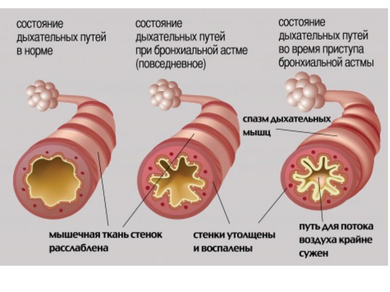 Бронхиальная астма рисунок